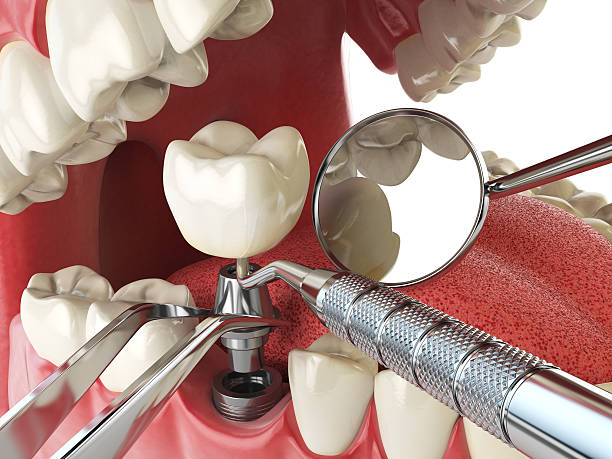 Best Broken or Chipped Tooth Repair in USA